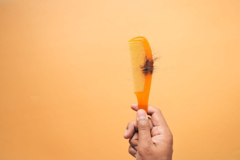 İngiltere'de alopesi areata için yeni tedavi seçeneği geldi