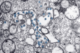 Parkinson Hastalığında Yeni Umut: Protein Birikimi Önleniyor