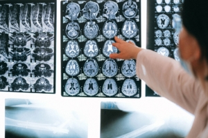 Beyindeki Ritmik Hücrelerin Alzheimer'deki Rolü