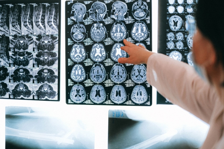 Beyindeki Ritmik Hücrelerin Alzheimer'deki Rolü